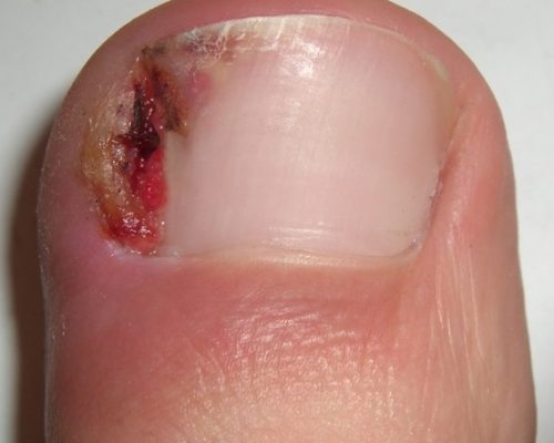 Ingrown_nail_002_cropped